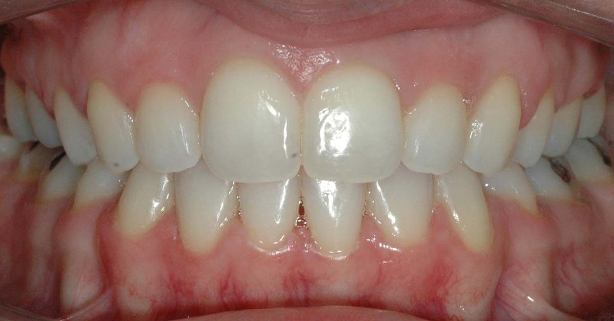 affollamento dentale adulti 1 1