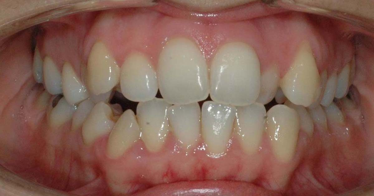 affollamento dentale adulti 2