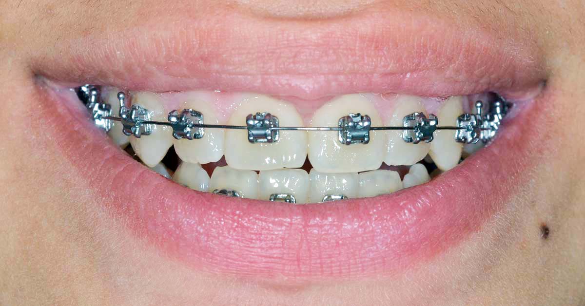 Apparecchi Ortodontici Fissi Attacchi Metallo Ceramica Studio Apparecchi Ortodontici Fissi Attacchi Metallo Ceramica Studio