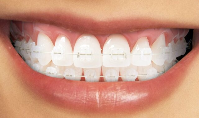Apparecchi ortodontici fissi