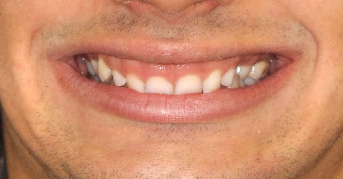 sorriso gengivale adolescenti