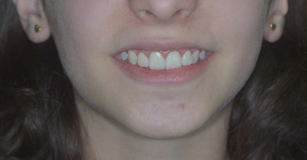 sorriso gengivale bambino 1