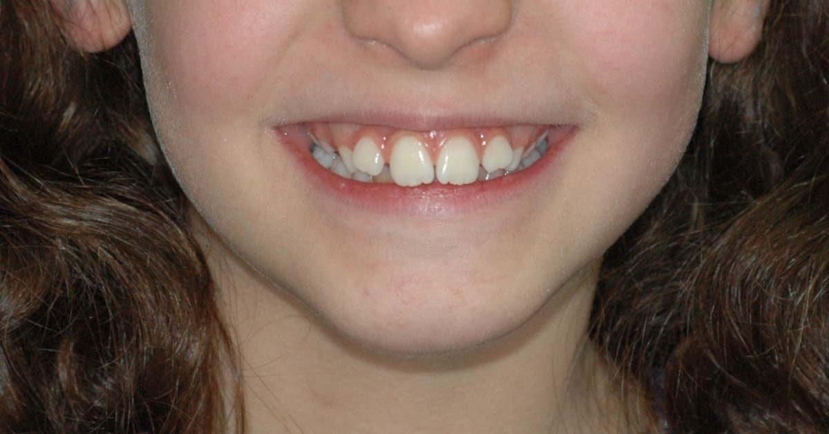 sorriso gengivale bambino